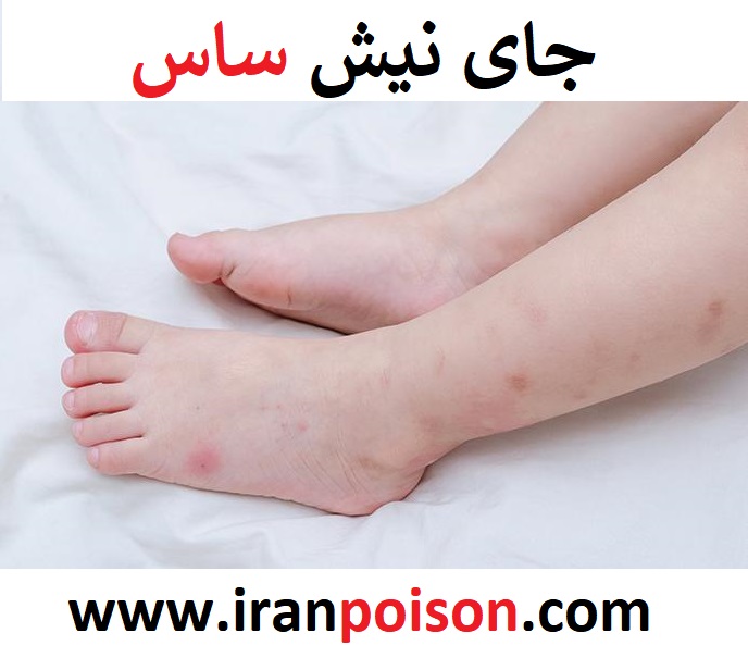 جای نیش ساس