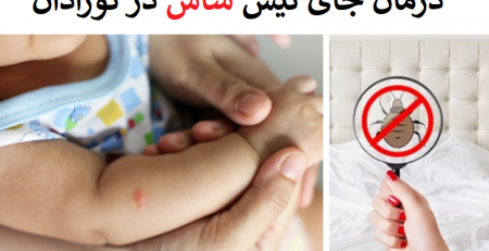 درمان جای نیش ساس در نوزادان