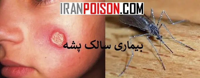 بیماری پشه سالک چجور بیماری هست؟- ایران سم