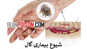 درمان شیوع بیماری گال