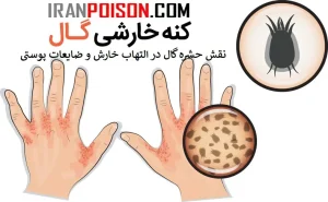 نقش حشره گال در التهاب خارش و ضایعات پوستی