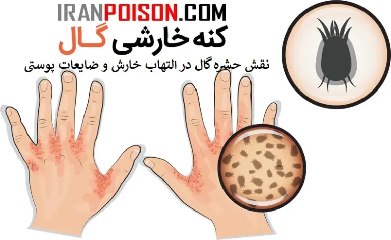 نقش حشره گال در التهاب خارش و ضایعات پوستی