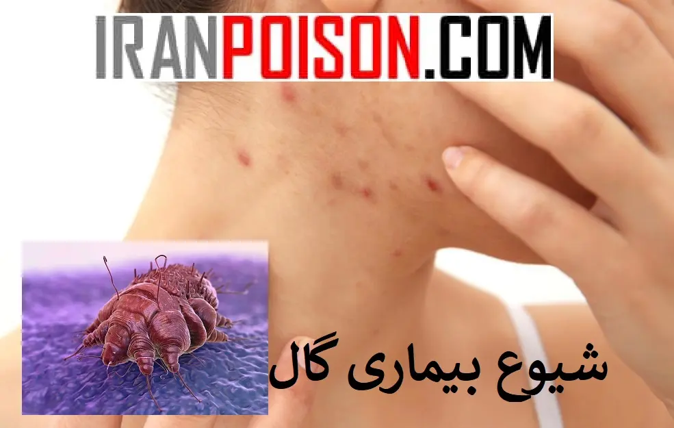 عوامل بیولوژیکی بیماری گال- ایران سم