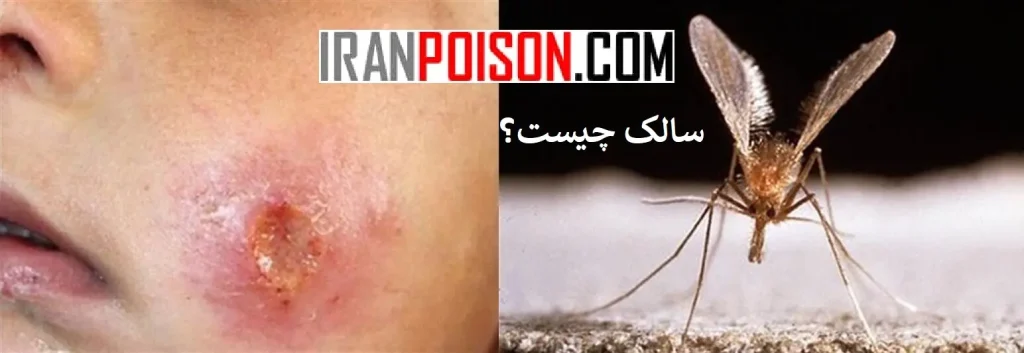 علائم بیماری سالک- ایران سم